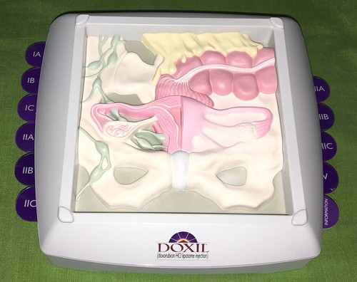 OVARIAN CANCER 3-D MODEL Female Uterus Vagina Cervix Anatomical Teaching OB GYN - Picture 1 of 6