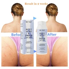 Butt Acne Clearing Spot Cream Clears Acne Pimples Zits Razor Bumps 100ml