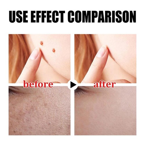 Wart Remover Serum Fast Safe Natural Treatment Skin C3J2 30ml Tags G7I7 Y8E2 - Picture 13 of 15