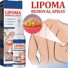 50ML Lipomheilung Reduction Spray, Instant LumpFree Lipoma Removal Spray USA Hot