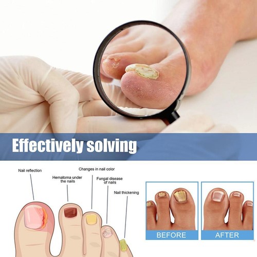 60x Toenail Fungus Treatment Sticker Nail Repair Patches Treatment Tool Kit Hot - Bild 8 von 12