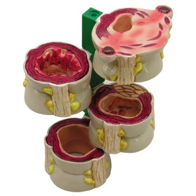 Colon 4-pc Diseased Anatomical Model GPI LFA #3341 SEE VIDEO Make