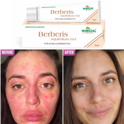Wheezal Berberis Aquifolium Gel (25g) Gel for managing both acne and dermatitis