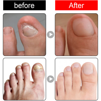 Ingrowth Toenail Correction Oil Ingrown Toenail Drops Nail Care For Ingrown SS5