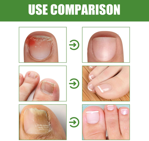 Nailshield Anti Fungal Stick,Monsalife Nail Shield Anti Fungal Stick Roll On - Bild 10 von 11