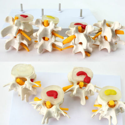 Human Anatomical Lumbar Vertebra Osteoporosis Diseased Contrast Medical Model