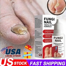 Fungi Nail Anti-Fungal Liquid Herbal Extracts Toenail Fungus Treatment Safe Us