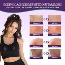 Silicone Scar Cream Scar Gel - Advanced Scar Gel Scar Treatment for Stretch..CR9