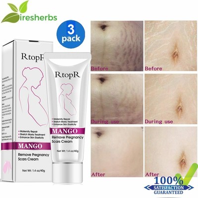 mango stretch mark cream