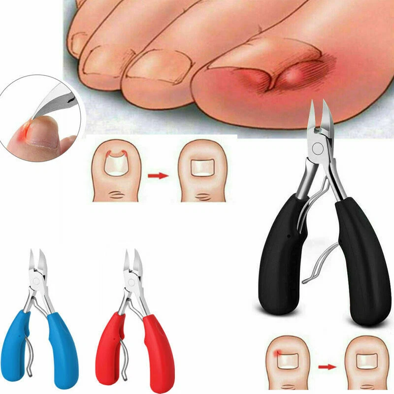 Ingrown 2024 toenail cutter