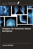 Imagen De Tumores óSeos Benignos Lynda Aoudia