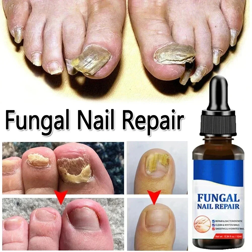 Chinese Nail Fungus Treatment Repair, Anti Fungal Nail Infection 