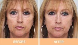 instant face lift