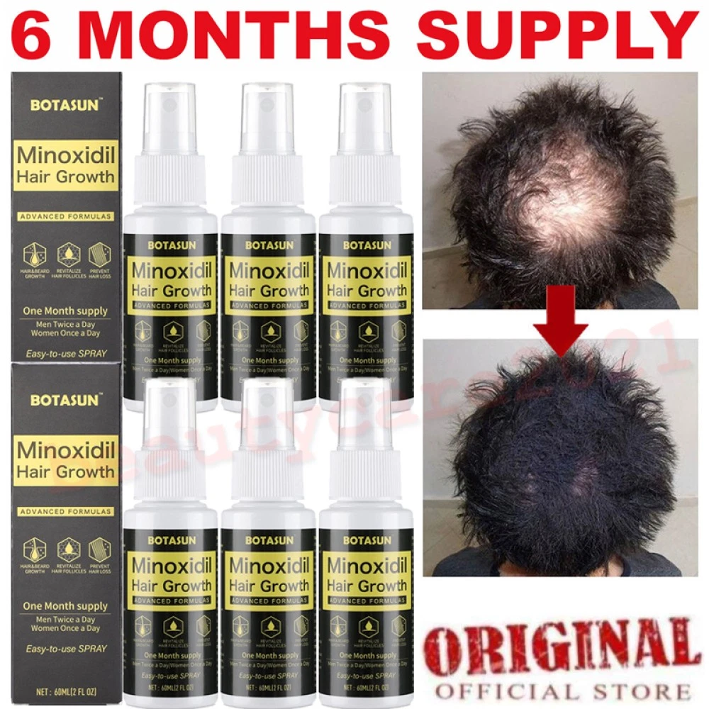 Minoxidil 5% Extras Strength Regrowth Treatment Serum Hair Growth Spray 6 Month
Opens in a new windo