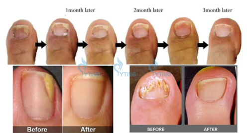 Máquina de eliminación de hongos en uñas láser diodo 980nm tratamiento de infección en uñas de los pies - Imagen 9 de 9
