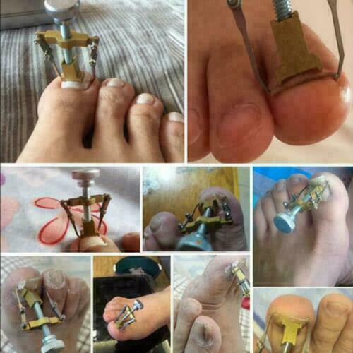 Herramienta de pedicura de uñas de pie de punta encarnada corrector de uñas *EE. UU. - Imagen 3 de 5