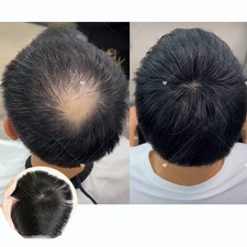 Clip In Silk Base Human Hair Toppers -For Loss Thin Hair  Replacement Straight