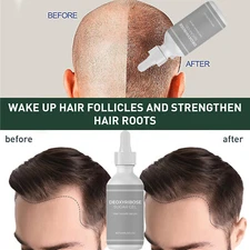 5 Pcs Deoxyribose Sugar Gel Hair Growth, Deoxyribose Serum for Hair Loss 60ml