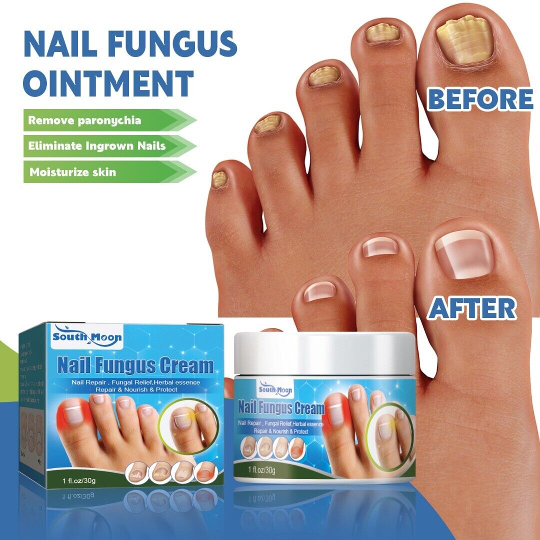 Fungal nail infection  NHS
