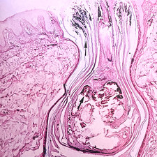 Vintage Acne Morphogenesis and Treatment Book...