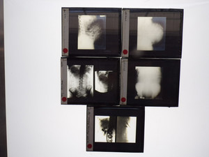 5 X-RAY LANTERN SLIDES PLATES MATERNITY FETUS IN CONTACT GASLIGHT BOX