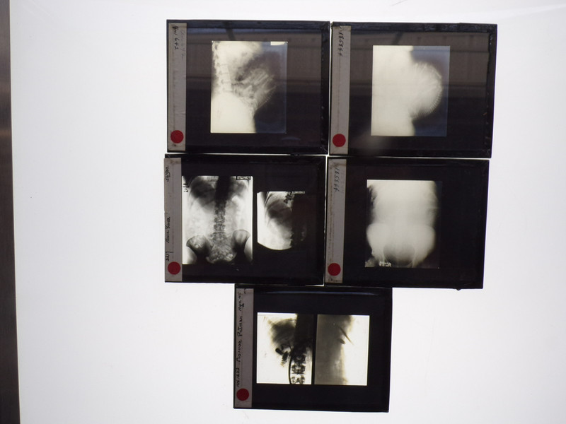 5 X-RAY LANTERN SLIDES PLATES MATERNITY FETUS IN CONTACT GASLIGHT BOX