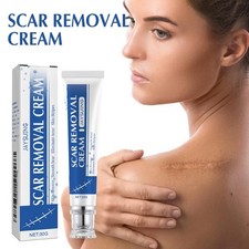 Scar Removal Cream for Surgical Acne Burn Scars Stretch Healing Gel 1-3PCS Marks