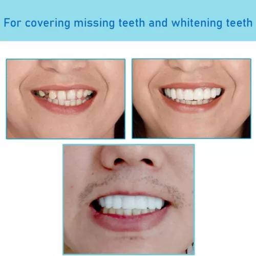 Set superiore e inferiore a scatto denti finti faccette dentali protesi copertura denti US - Foto 7 di 12