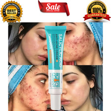 Salicylic Acid Strong Acne Removal Cream Anti Acne Pimple Scars Spots Clean US