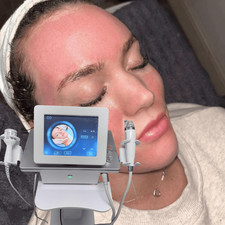 2in1 Rf Micro-n-eedle Machine Cold Hammer Anti Scars Spot Wrinkle Removal Beauty 2in1 Rf Micro-n-eedle Machine Cold Hammer Anti Scars Spot Wrinkle Removal Beauty