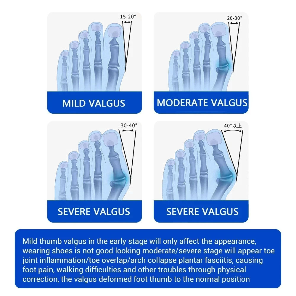 Bunion Fix Toe Valgus Corrector Adjustable Orthosis Women Men Splints*