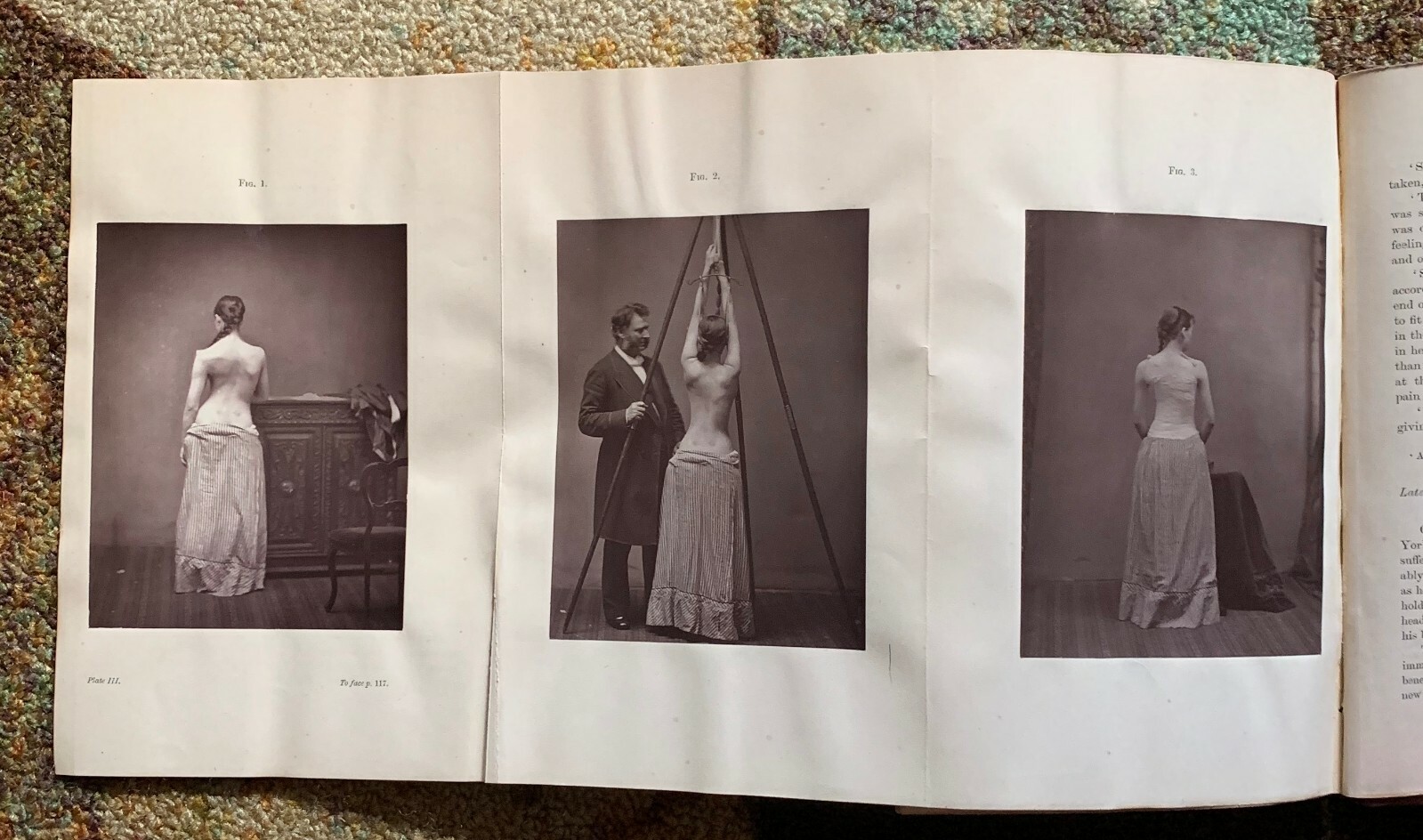 1877 Spinal Disease Curvature Sayre 1st Ed Rare Medical Book