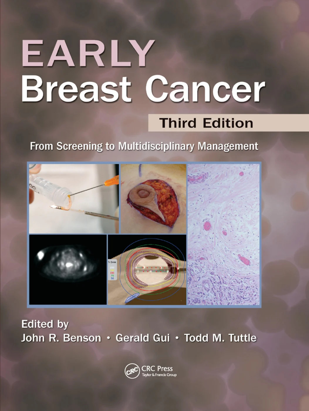 Early Breast Cancer - 3rd Edition