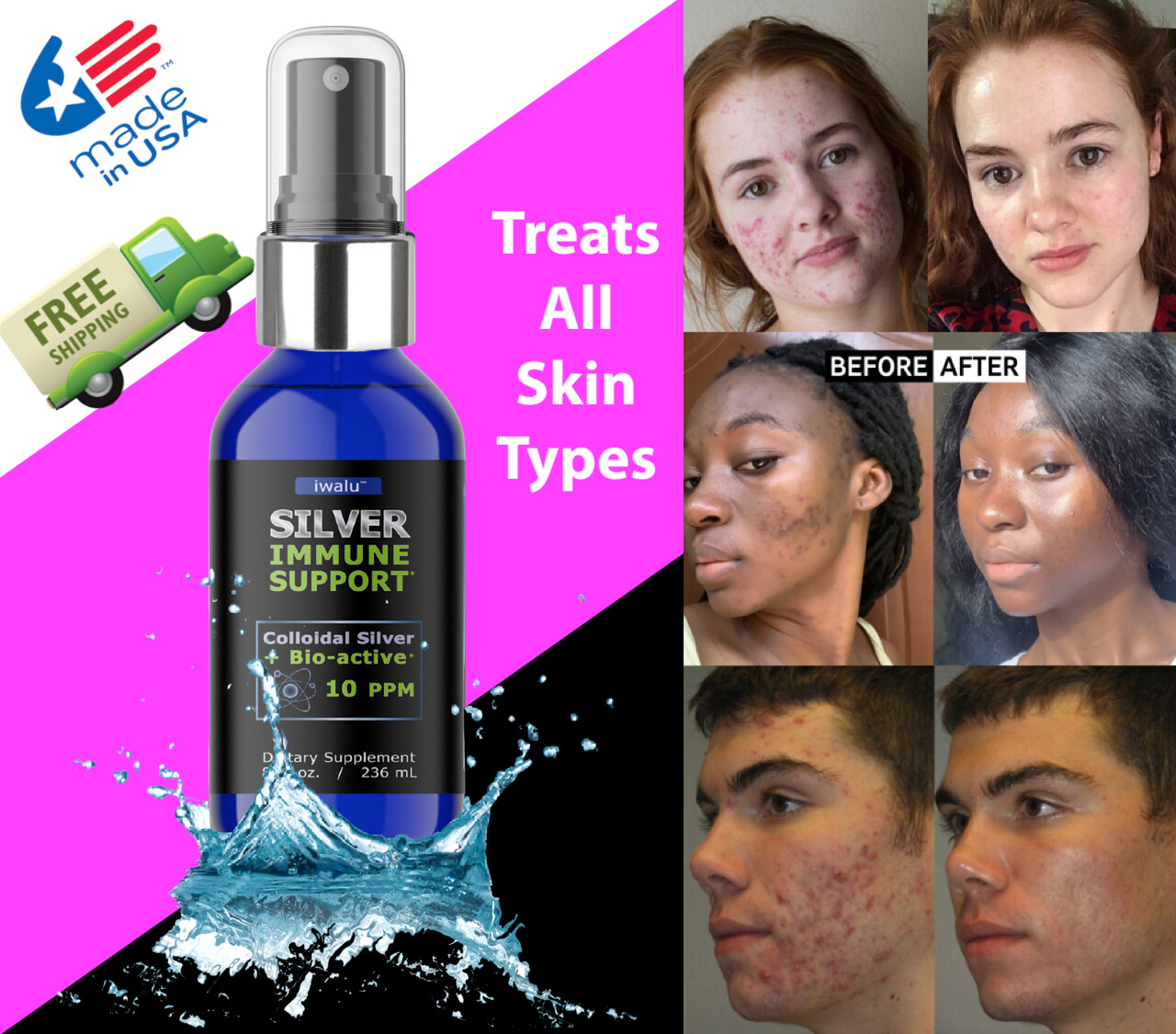SOOTHING MOISTURIZER - PREVENT HEAL PIMPLE ACNE Rash - Daily Antibacterial Cure
