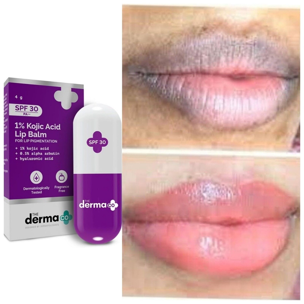 kojic acid and vitamin c lip balm The Derma Co 1% Kojic Acid Lip Balm For Dark & Pigmented Lips