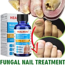 Extra Strength Toenail Fingernail Fungus Treatment Nail Repair Renewal Solution