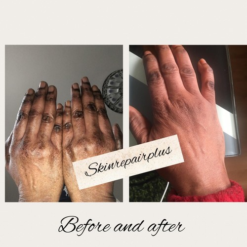 Crème SOIN Effaceur d'hyperpigmentation pour phalanges, pieds - Zdjęcie 6 z 17