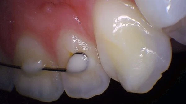 Cámara intraoral PerfectCam HD, cámara dental USB, software gratuito de botón de captura. Foto 4 de 4