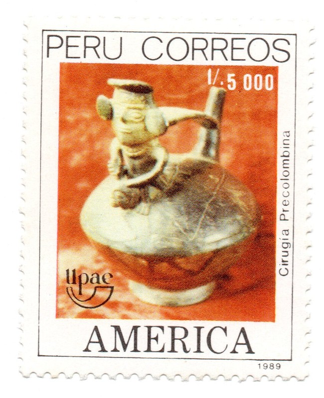 Pre Columbian Ancestral Surgery in ceramics, UPAE, Peru 1989, accept offers 1