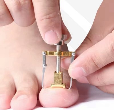 Ingrown Toenail Corrector Tools Pedicure Recover Embed Toe Nail Treatment Profes