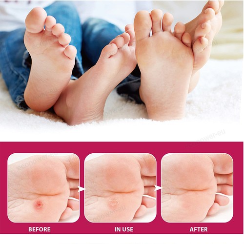 24/48x Corn Removal Patch Toe Callus Corn Remover Pads Wart Treatment Patch Foot - Picture 5 of 19
