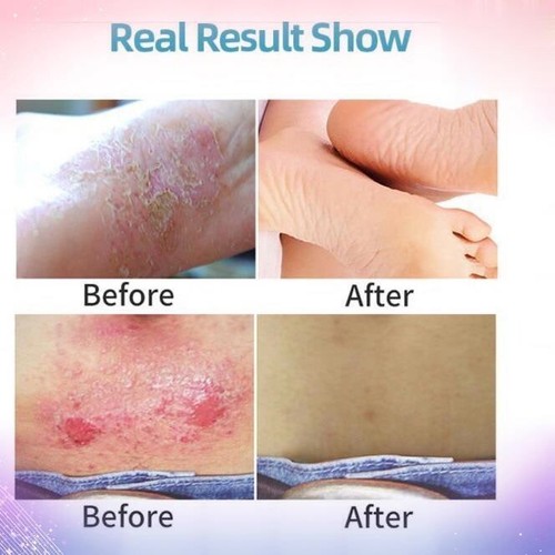 COMBIDERM CREAM FOR BABY & ADULT - Picture 7 of 7