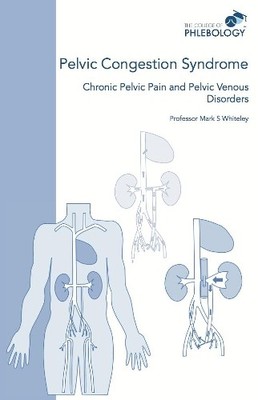 Mark S Whiteley Pelvic Congestion Syndrome - Chronic Pelvic Pain and (Paperback)