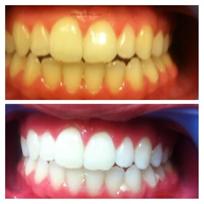 Very Strong Teeth Whitening Gel MADE IN EU 36 Professional Dental Grade 10ml Gel