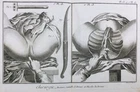 Gynecologist IN 1779 Surgical Perineum Rare Engraving Medicine Encyclopédie