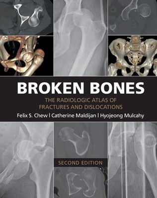 Broken Bones The Radiologic Atlas of Fractures and Dislocations Chew Maldijan 2e