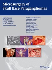 Microsurgery of Skull Base Paragangliomas Mar...