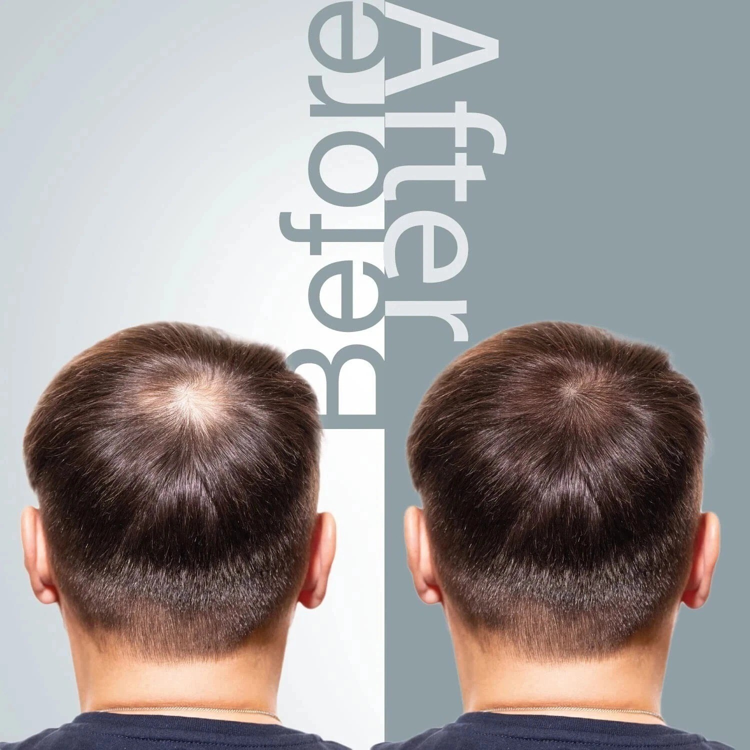 The Mossi London 6 Months Flacon Plus Hair Set - Mossi Anti Hair Loss FULL Kit