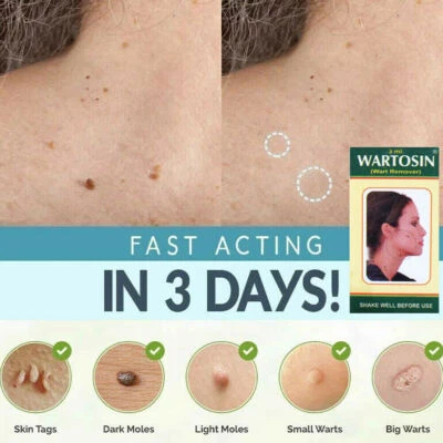 WARTOSIN NEW SKIN TAG REMOVER CREAM SAFE FAST WART REMOVAL MOLE ACNE PIMPLE PATCH SPOT US