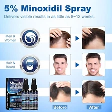 2 Bottles 5% Minoxidil Hair Growth Spray for Men Women Hair Loss Regrow Thinning